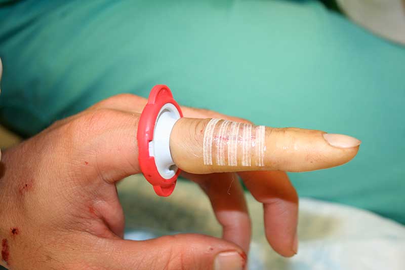 Steri strips ok